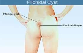 Pilonidal sinüs risk yerleri